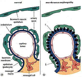 spike and dome appearance kidney